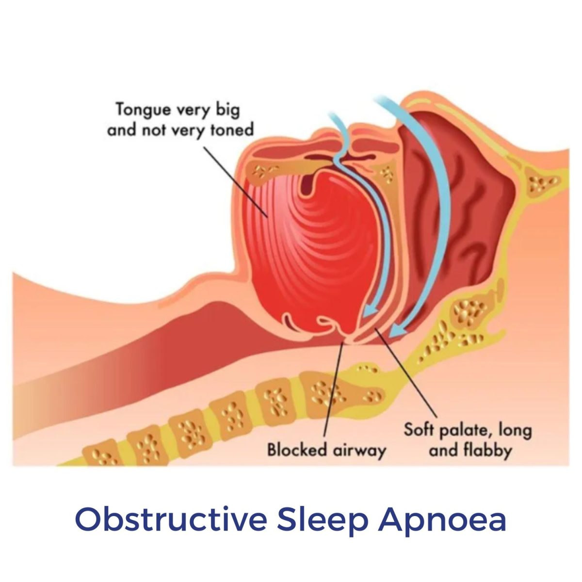 Obstructive Sleep Apnoea airway diagram | Intus Healthcare